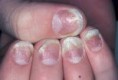 The British Journal of Dermatology Nail Involvement as a Predictor of Concomitant Psoriatic Arthritis in Patients With Psoriasis
